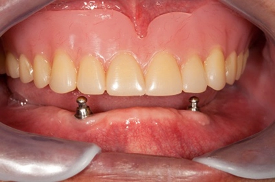 Snap on dentures