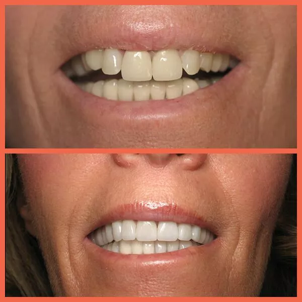 Before-After-patient-dental-crowns_Salt_Lake_City_UT