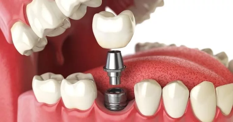 single teeth crown implants