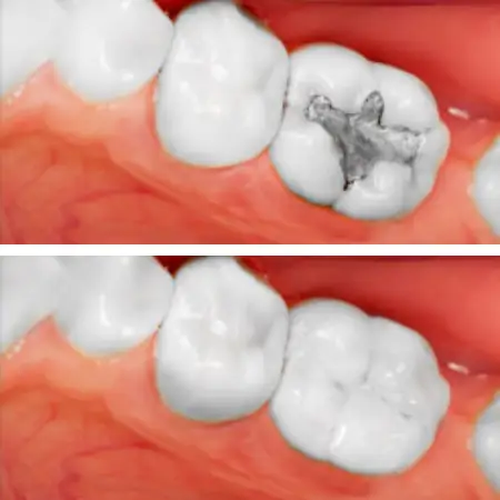 Dental Fillings to Repair a Cracked Tooth - Lush Dental Co. Highland Utah