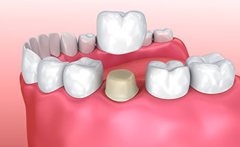 Application of dental crowns