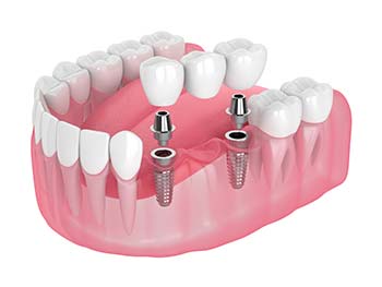 Image of dental bridge