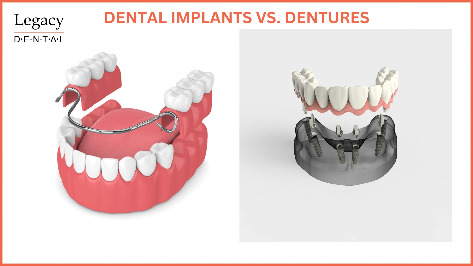 Dental implants VS. dentures