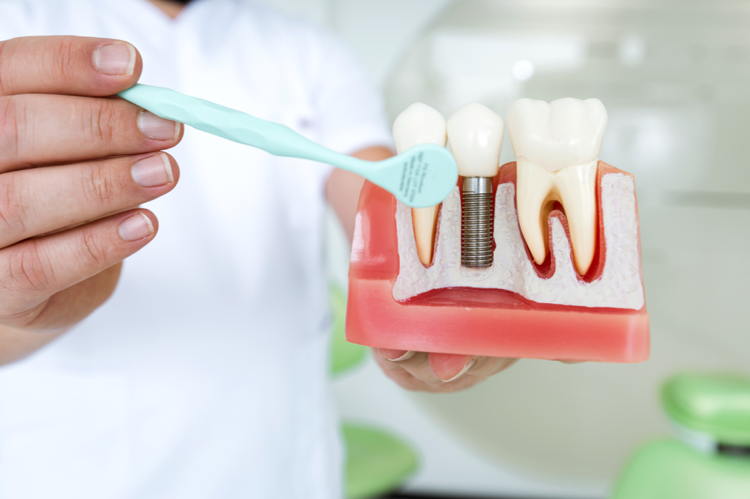 What Are Dental Implants Made Of?