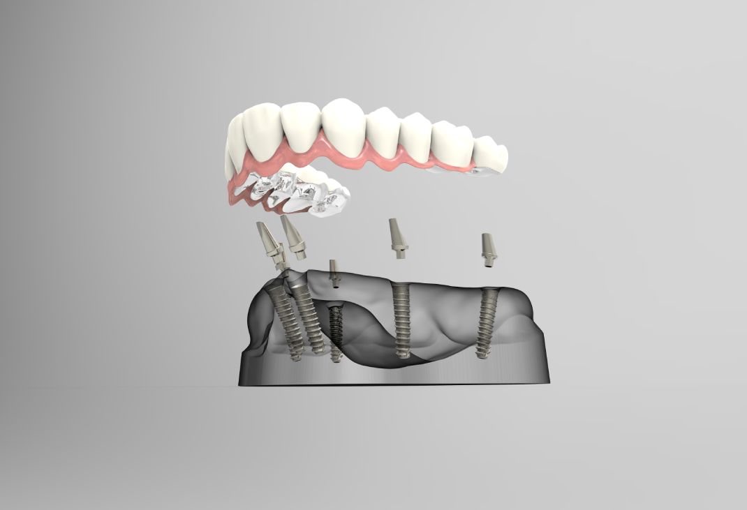 How Much Do Full-Mouth Dental Implants Cost?