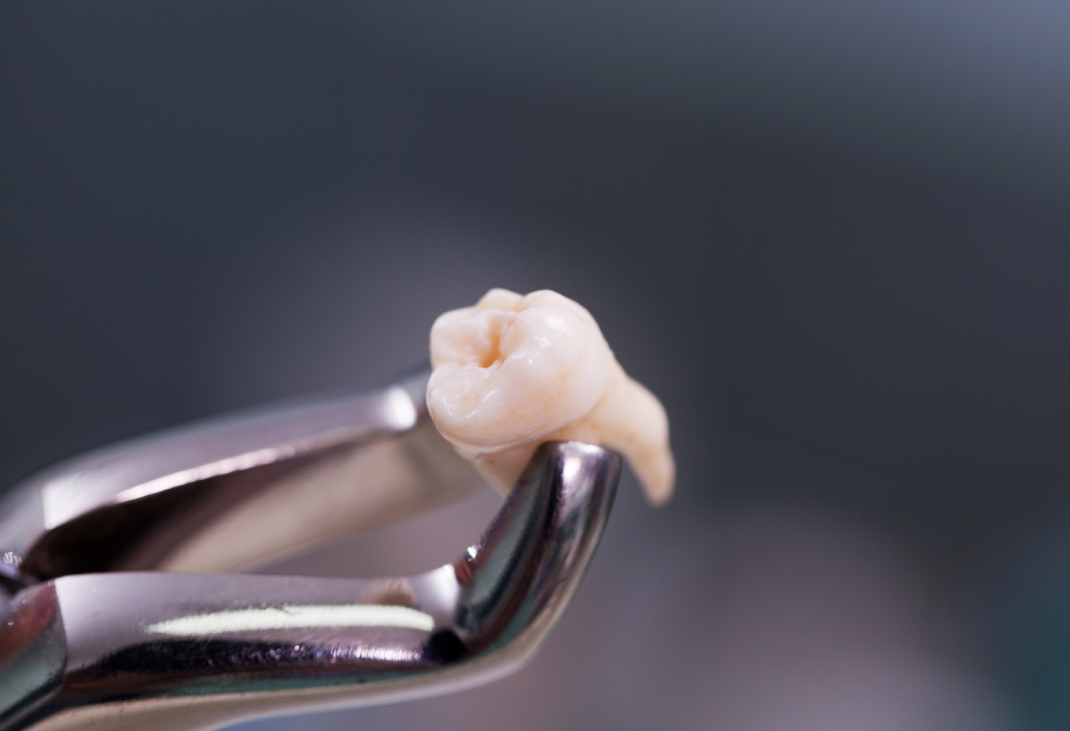 How to Pull Out a Tooth