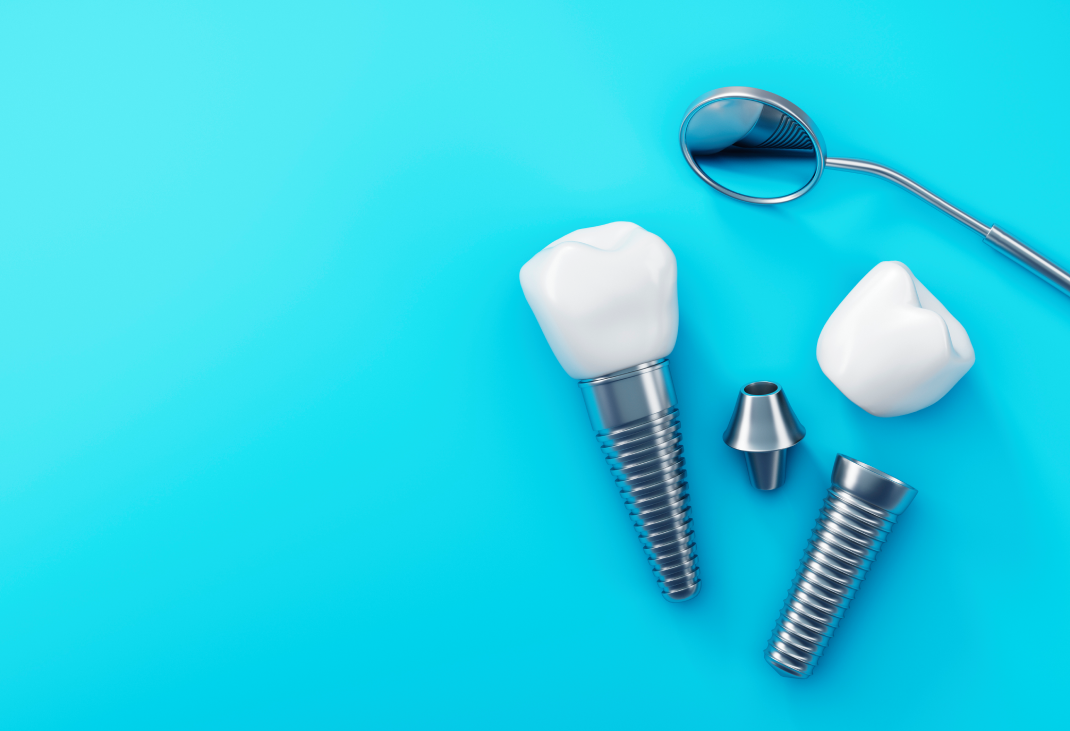 What Are Screwless Dental Implants?